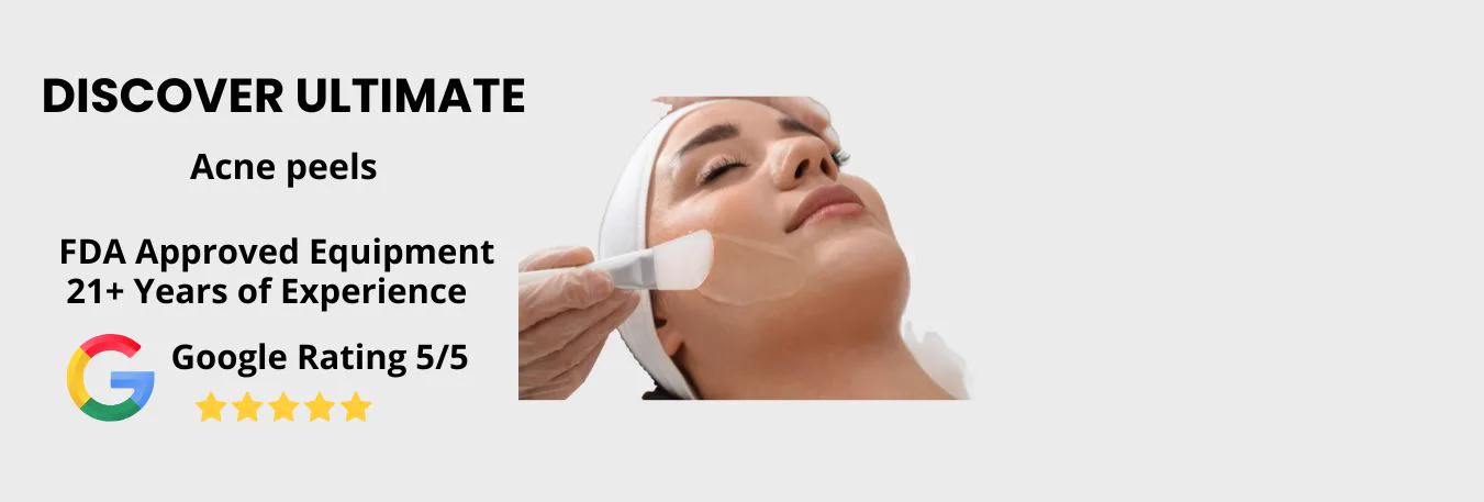 Acne Scar Treatment