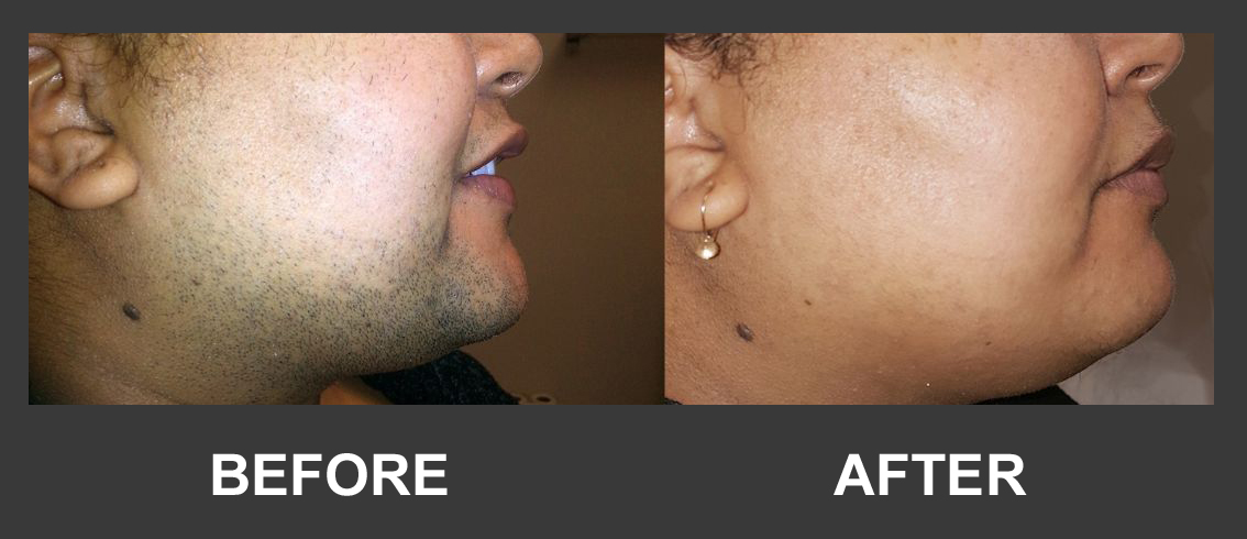 Before and after facial hair reduction result