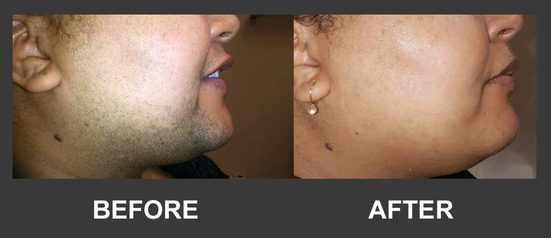 Before and after facial hair reduction result