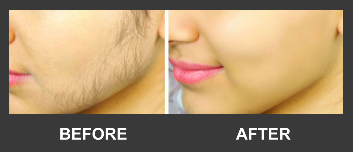 Before and after facial hair removal result