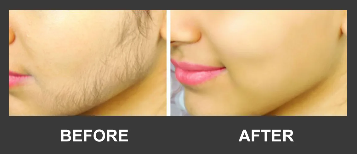 Before and after facial hair removal result