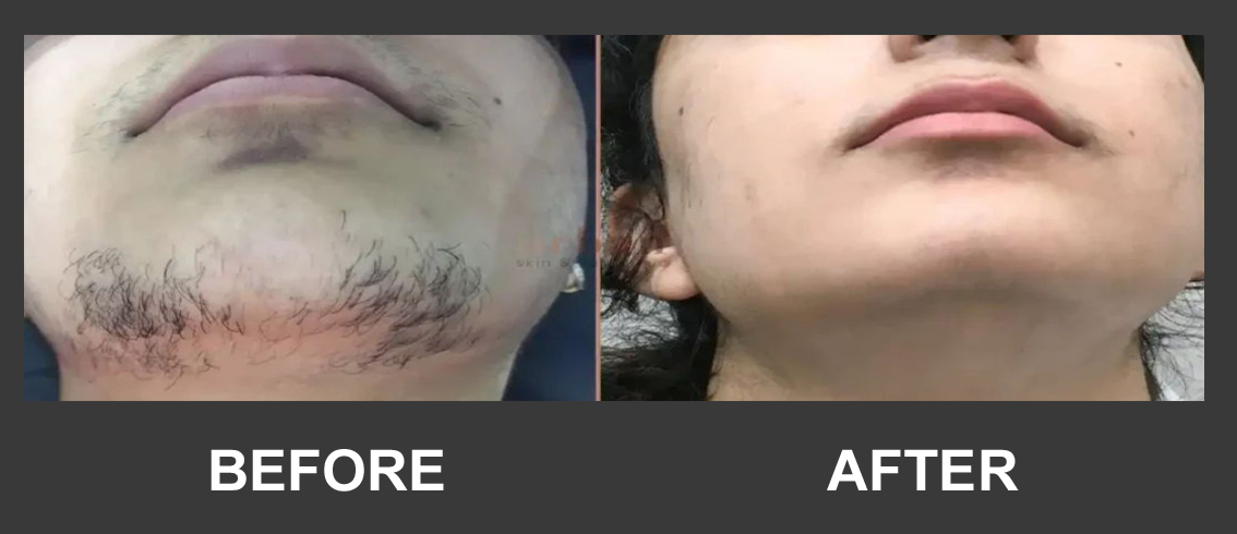Before and after chin hair reduction result