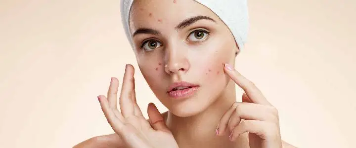 Active Acne
