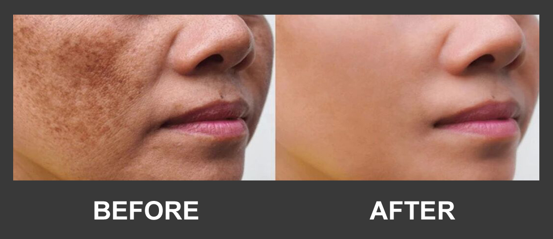 Before and after pigmentation treatment result