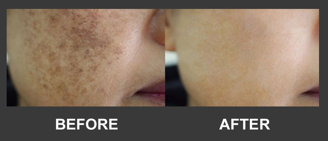 Before and after pigmentation treatment result