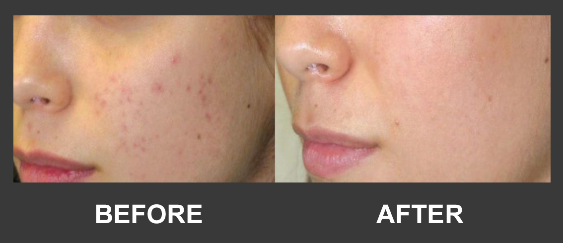 Before and after acne treatment result